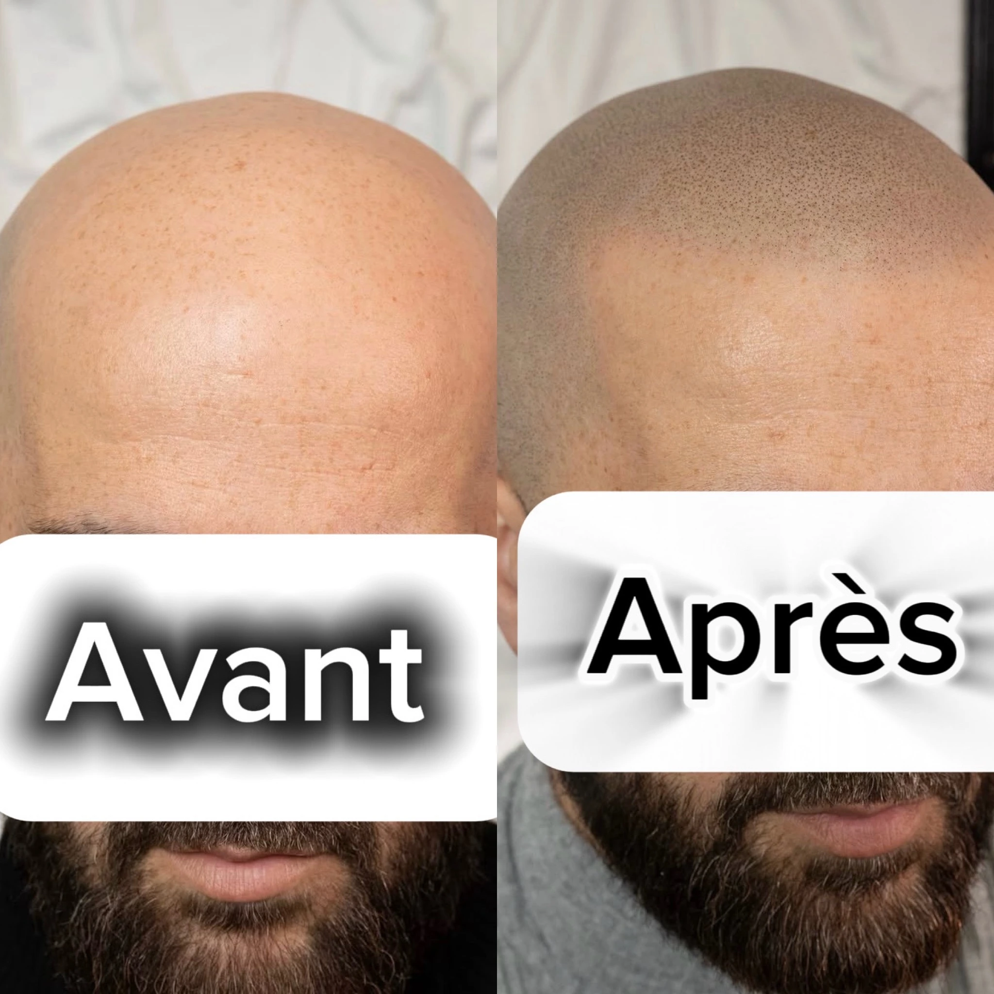 Photos avant et après de tricopigmentation : gros plan du cuir chevelu et de la ligne frontale avec effet rasé