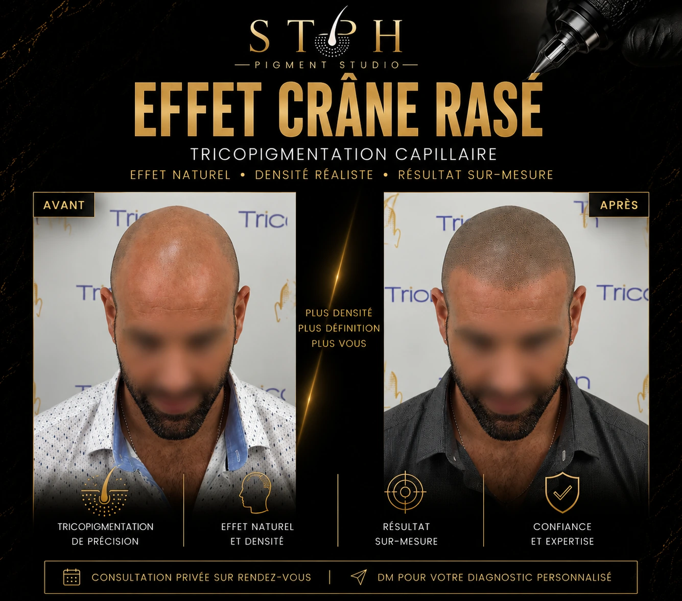 Visuel STPH effet crâne rasé : comparaison avant et après de face, ligne frontale et cuir chevelu