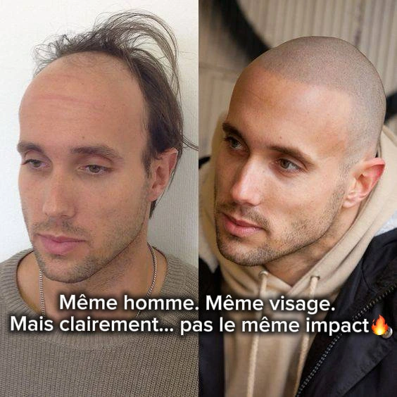Comparaison avant et après fournie par le salon : cheveux clairsemés puis apparence de crâne rasé, vue de trois quarts